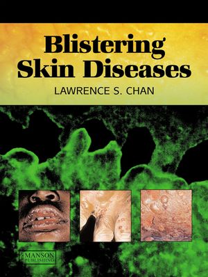 ISBN 9781840760668 Blistering Skin Diseases Lawrence Chan 本・雑誌・コミック 画像