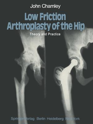 ISBN 9783642670152 Low Friction Arthroplasty of the Hip: Theory and Practice Softcover Repri/SPRINGER NATURE/J. Charnley 本・雑誌・コミック 画像